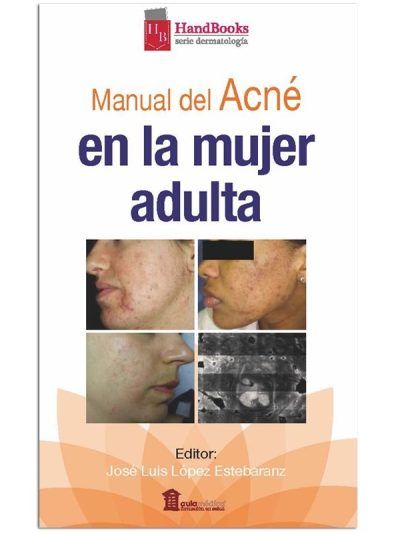 Manual Del Acné En La Mujer Adulta 1 Edición