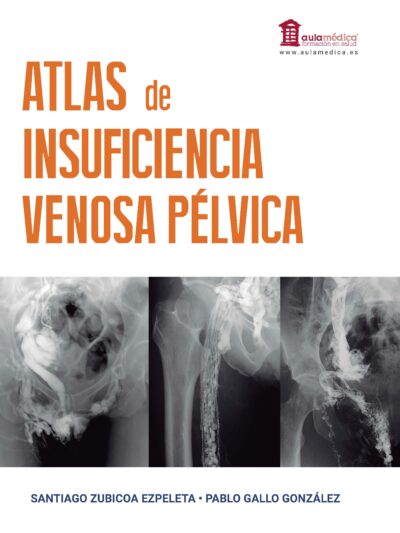ATLAS DE INSUFICIENCIA VENOSA PÉLVICA